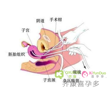 喜孕多告诉你:无痛人流真的安全吗?