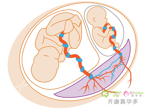 试管婴儿能不能双胎是由什么决定的？