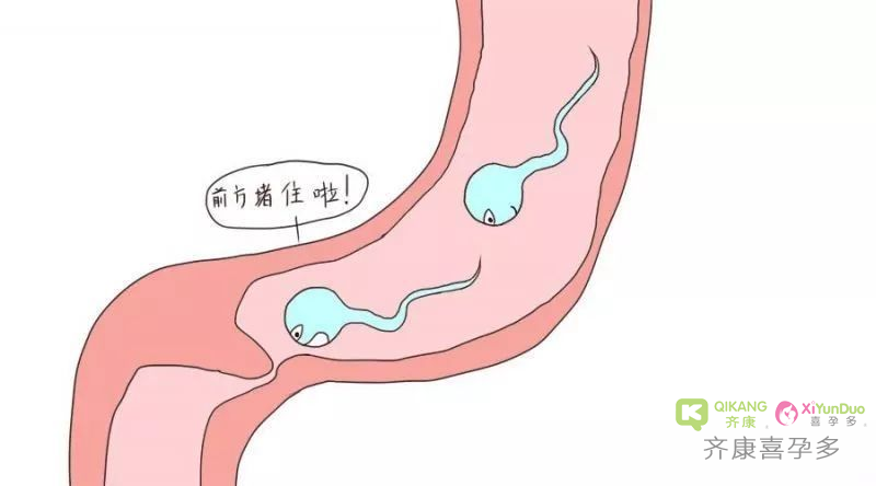 输卵管堵塞可以试管吗？