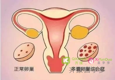 多囊患者，一定要辅助生殖怀孕吗？