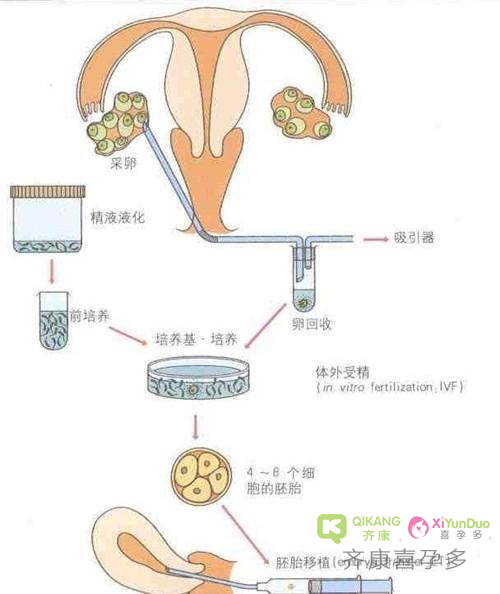 第三代试管婴儿的流程有哪些？