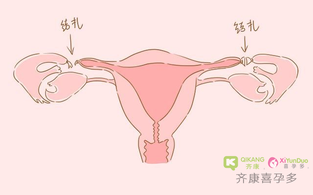 喜孕多告诉你：男性结扎与女性结扎，会有什么区别？