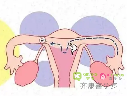 子宫粘连可以做试管婴儿吗？