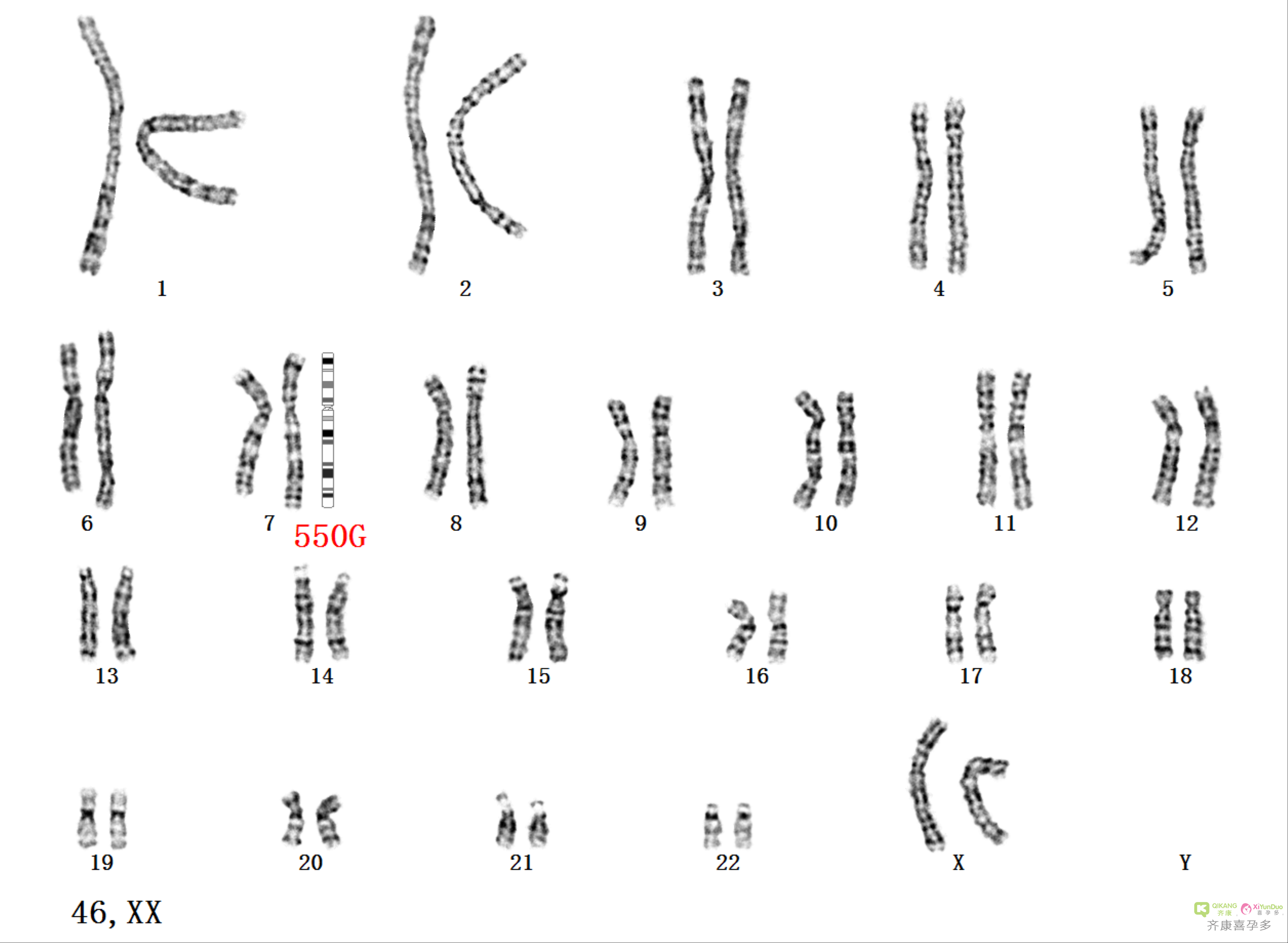 什么是染色体异常？染色异常几代试管婴儿可以解决?