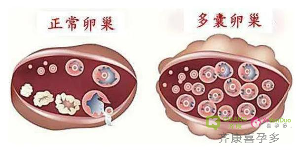 什么是多囊？多囊的危害是什么？