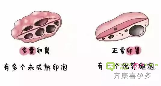 什么是多囊？多囊的危害是什么？