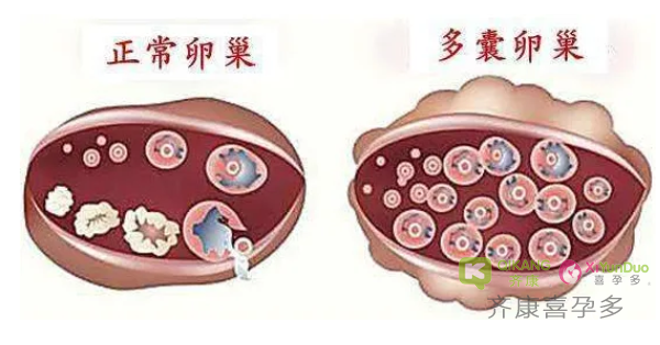 什么是多囊？多囊应该全面了解疾病科学应对？