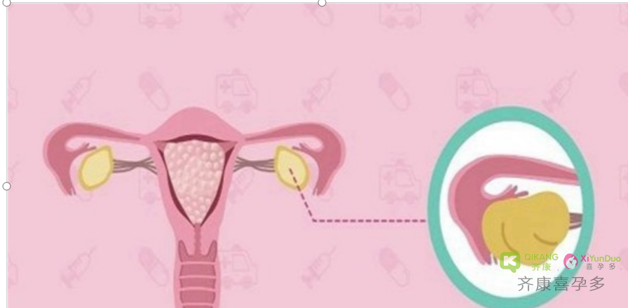 什么是三代试管婴儿？为什么试管移植前要检查子宫内膜？