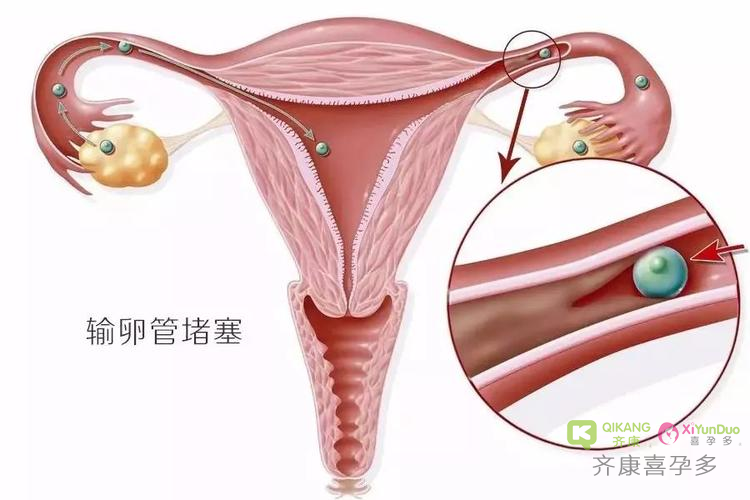 导致输卵管堵塞的原因有哪些？输卵管堵塞可以直接试管吗？