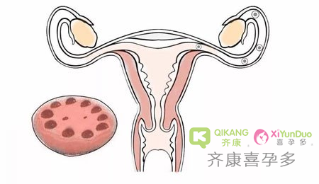 多囊的症状是什么？多囊可以做试管吗？