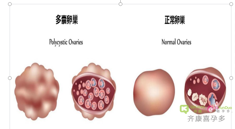 多囊的症状是什么？多囊可以做试管婴儿吗？