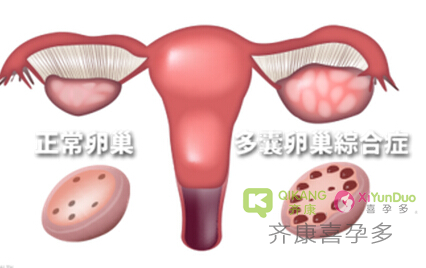 多囊卵巢综合征的治疗方法有哪些？需要注意以下那几点？
