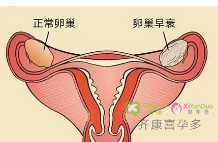 什么是卵巢早衰？卵巢早衰对女性有何影响？