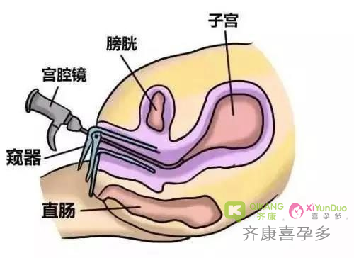 为什么胚胎移植前医生建议做宫腔镜检查？哪些情况要做宫腔镜？