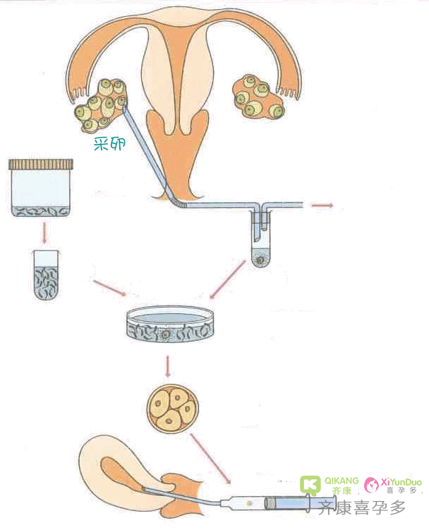 什么是试管婴儿？试管婴儿的全流程是什么？
