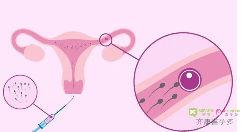 什么是输卵管堵塞？输卵管堵塞几代试管可以解决？