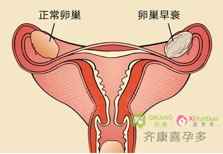 什么是卵巢早衰？为什么有些女性年纪轻轻就出现了卵巢早衰？