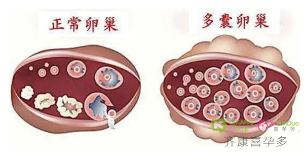 什么是多囊？多囊卵巢在不同时期，应该如何调理？