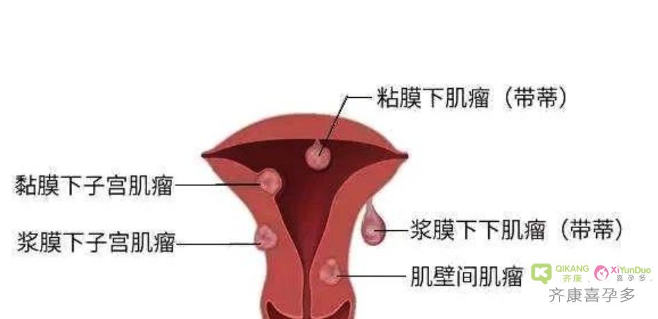 什么是子宫肌瘤？子宫肌瘤影不影响做试管婴儿？