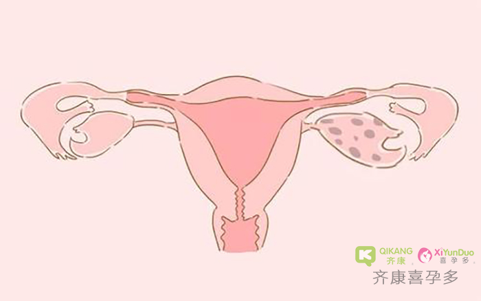 什么是子宫肌瘤？子宫肌瘤影不影响做试管婴儿？