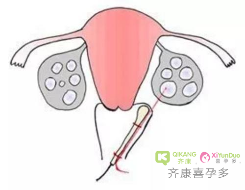 冻卵前有哪些准备？取卵后注意事项有哪些？