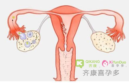 多囊的症状是什么？多囊患者做试管婴儿有哪些准备工作呢？